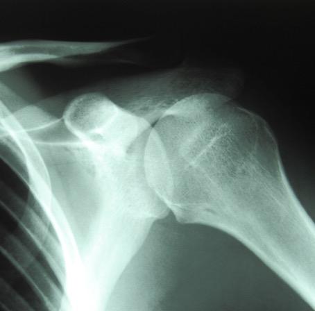 Shoulder X-ray Image