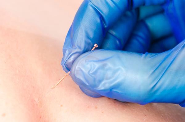 Dry Needling